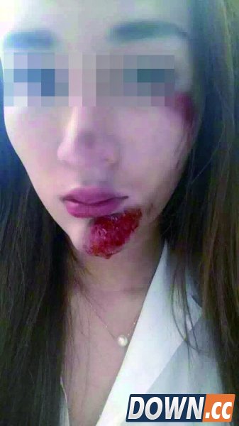 杨小姐称，她脸上的伤是被专车司机所打 摄/法制晚报记者 苏妮