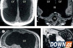 男子腿疼就医 却被查出大脑已消失过半